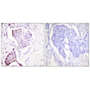 Immunohistochemistry analysis of paraffin-embedded human breast carcinoma tissue, using Ubiquitin antibody.