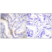 Immunohistochemistry analysis of paraffin-embedded human lung carcinoma tissue, using urocortin antibody.
