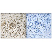Immunohistochemistry analysis of paraffin-embedded human breast carcinoma tissue, using CIB2 antibody.