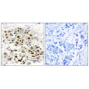 Immunohistochemistry analysis of paraffin-embedded human breast carcinoma tissue, using MAP3K6 antibody.