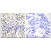 Immunohistochemistry analysis of paraffin-embedded human lung carcinoma tissue, using KAD1 antibody.