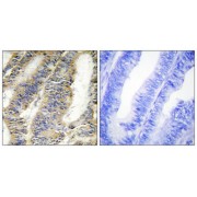 Immunohistochemistry analysis of paraffin-embedded human colon carcinoma tissue, using TNF alpha antibody.