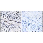 Immunohistochemistry analysis of paraffin-embedded human lung carcinoma tissue, using ZNF76 antibody.