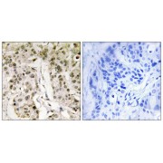 Immunohistochemistry analysis of paraffin-embedded human breast carcinoma tissue, using HCFC1 antibody.