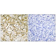 Immunohistochemistry analysis of paraffin-embedded human liver carcinoma tissue, using TFAM antibody.