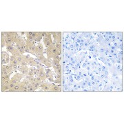 Immunohistochemistry analysis of paraffin-embedded human liver carcinoma tissue, using TNAP2 antibody.