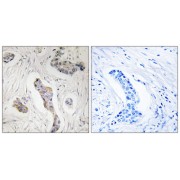 Immunohistochemistry analysis of paraffin-embedded human breast carcinoma tissue, using K0100 antibody.