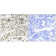 Immunohistochemistry analysis of paraffin-embedded human breast carcinoma tissue, using BATF antibody.