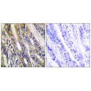 Immunohistochemistry analysis of paraffin-embedded human colon carcinoma tissue, using DGKH antibody.