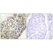 Immunohistochemistry analysis of paraffin-embedded human breast carcinoma tissue, using LATH antibody.