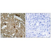 Immunohistochemistry analysis of paraffin-embedded human breast carcinoma tissue, using BTBD6 antibody.