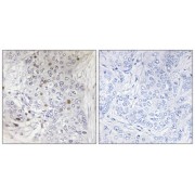 Immunohistochemistry analysis of paraffin-embedded human breast carcinoma tissue, using MAFF antibody.