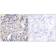 Immunohistochemistry analysis of paraffin-embedded human breast carcinoma tissue using COL5A2 antibody.