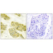 Immunohistochemistry analysis of paraffin-embedded human breast carcinoma tissue using COL5A3 antibody.