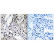 Immunohistochemistry analysis of paraffin-embedded human breast carcinoma tissue using PHLDA3 antibody.