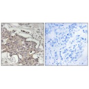 Immunohistochemistry analysis of paraffin-embedded human breast carcinoma tissue using HIBADH antibody.