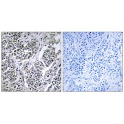 Immunohistochemistry analysis of paraffin-embedded human lung carcinoma tissue using ATP5D antibody.