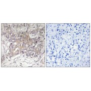 Immunohistochemistry analysis of paraffin-embedded human liver carcinoma tissue using GCNT3 antibody.