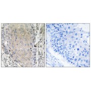 Immunohistochemistry analysis of paraffin-embedded human lung carcinoma tissue using CBLN3 antibody.