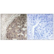 Immunohistochemistry analysis of paraffin-embedded human breast carcinoma tissue using CSGALNACT1 antibody.