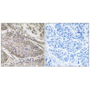 Immunohistochemistry analysis of paraffin-embedded human lung carcinoma tissue using PLA2G4E antibody.