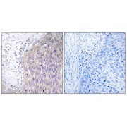 Immunohistochemistry analysis of paraffin-embedded human cervix carcinoma tissue using POLG2 antibody.