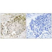 Immunohistochemistry analysis of paraffin-embedded human lung carcinoma tissue using RFX2 antibody.