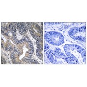 Immunohistochemistry analysis of paraffin-embedded human colon carcinoma tissue using GTPBP2 antibody.