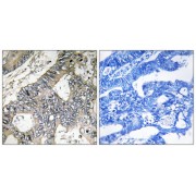 Immunohistochemistry analysis of paraffin-embedded human colon carcinoma tissue using GUF1 antibody.