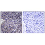 Immunohistochemistry analysis of paraffin-embedded human lung carcinoma tissue using USP50 antibody.