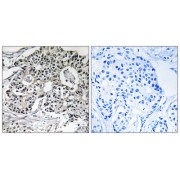 Immunohistochemistry analysis of paraffin-embedded human breast carcinoma tissue using PXMP2 antibody.