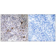 Immunohistochemistry analysis of paraffin-embedded human lung carcinoma tissue using RAB11FIP3 antibody.