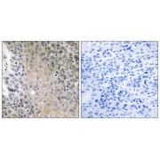 Immunohistochemistry analysis of paraffin-embedded human lung carcinoma tissue using RAB41 antibody.