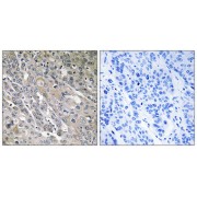 Immunohistochemistry analysis of paraffin-embedded human lung carcinoma tissue using ARHGEF9 antibody.