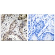 Immunohistochemistry analysis of paraffin-embedded human colon carcinoma tissue using TUT1 antibody.