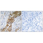 Immunohistochemistry analysis of paraffin-embedded human breast carcinoma tissue using USP32 antibody.