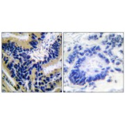 Immunohistochemical analysis of paraffin-embedded human lung carcinoma tissue, using Caspase 3 (cleaved-Asp175) antibody.