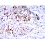 Immunohistochemical analysis of paraffin-embedded mammary cancer tissues using SCGB2A2 antibody with DAB staining.