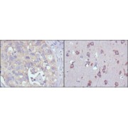 Immunohistochemical analysis of paraffin-embedded human lung cancer (left) and human brain (right) tissues using MPS1 antibody with DAB staining.