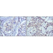 Immunohistochemical analysis of paraffin-embedded human lung cancer (left) and breast cancer (right) using RTN3 antibody with DAB staining.