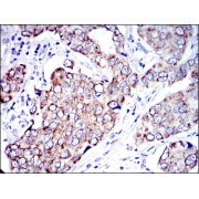 Immunohistochemical analysis of paraffin-embedded human cervical cancer tissues using AIF antibody with DAB staining.