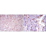 Immunohistochemical analysis of paraffin-embedded human breast cancer tissues (left) and human esophageal cancer tissues (right) using CD133 antibody with DAB staining.
