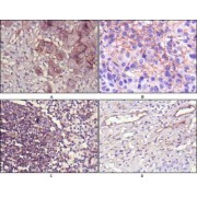 Immunohistochemical analysis of paraffin-embedded human lung cancer (A), cholangiocarcinorna (B), lymph node (C) and esophagus (D) tissues using NT5E antibody with DAB staining.