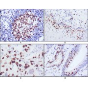 Immunohistochemical analysis of paraffin-embedded human lymph node (A), esophagus (B), lung cancer (C), rectum cancer (D), showing nuclear localization using KI67 antibody with DAB staining.
