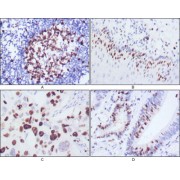 Immunohistochemical analysis of paraffin-embedded human lymph node (A), esophagus (B), lung cancer (C), rectum cancer (D), showing nuclear localization using KI67 antibody with DAB staining.