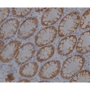 IHC analysis (400X) of CK19 expression in colon cancer, using CK19 antibody (1:1000 dilution).