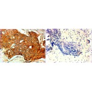 abx430514 (4 µg/ml staining of paraffin embedded Human breast cancer (Her+ left, triple negative right). Steamed antigen retrieval with citrate buffer pH 6, HRP-staining.