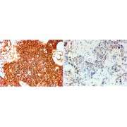 abx430515 (4 µg/ml staining of paraffin embedded Human breast cancer (Her+ left, triple negative right). Steamed antigen retrieval with citrate buffer pH 6, HRP-staining.