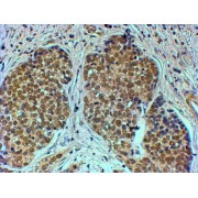 abx430617 (4 µg/ml staining of paraffin embedded Human Breast cancer. Steamed antigen retrieval with citrate buffer pH 6, HRP-staining.
