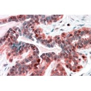 abx431995 (3.8 µg/ml staining of paraffin embedded Human Breast Steamed antigen retrieval with citrate buffer pH 6, AP-staining.